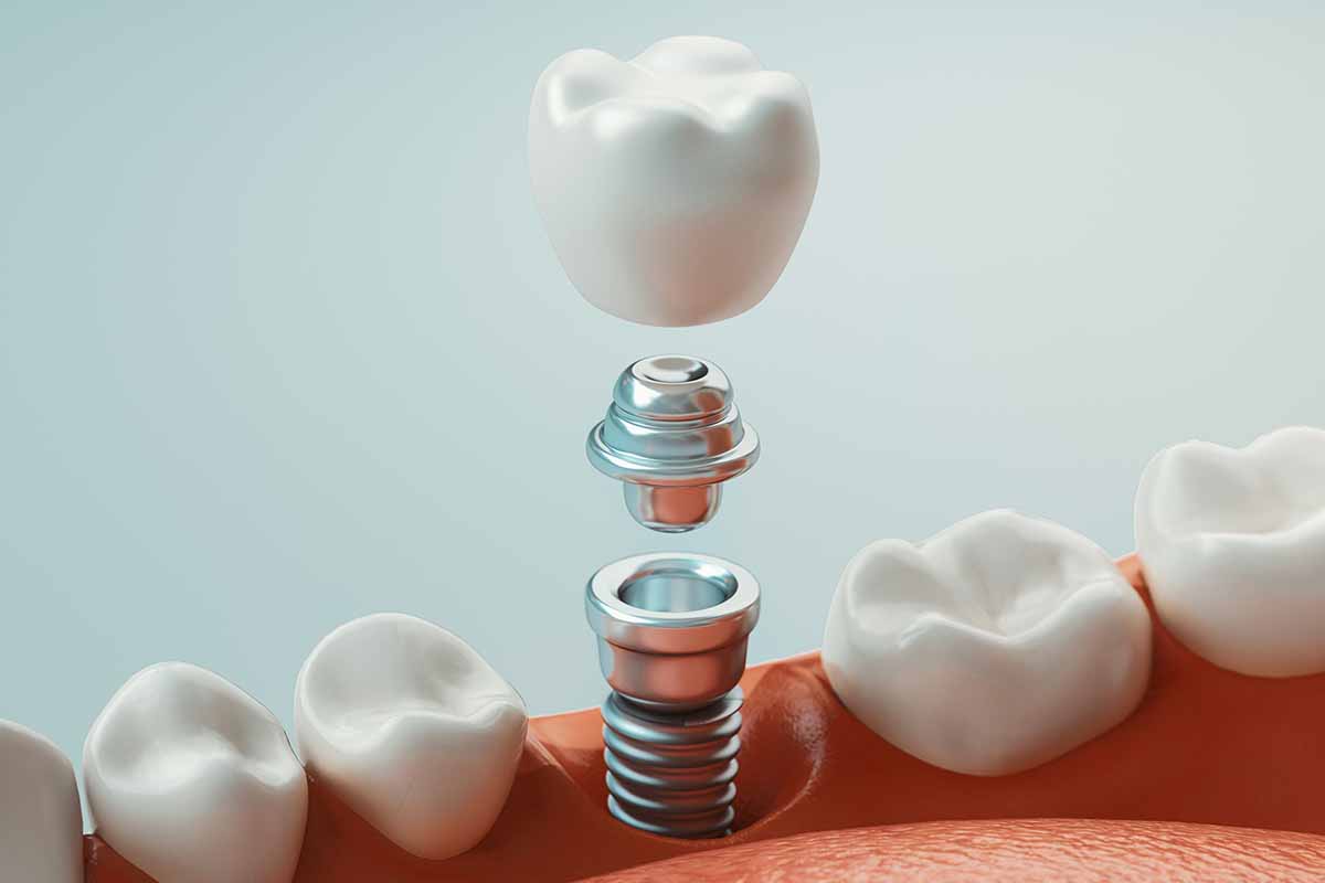 Kadıköy İmplant Tedavisi - Kemik Dental