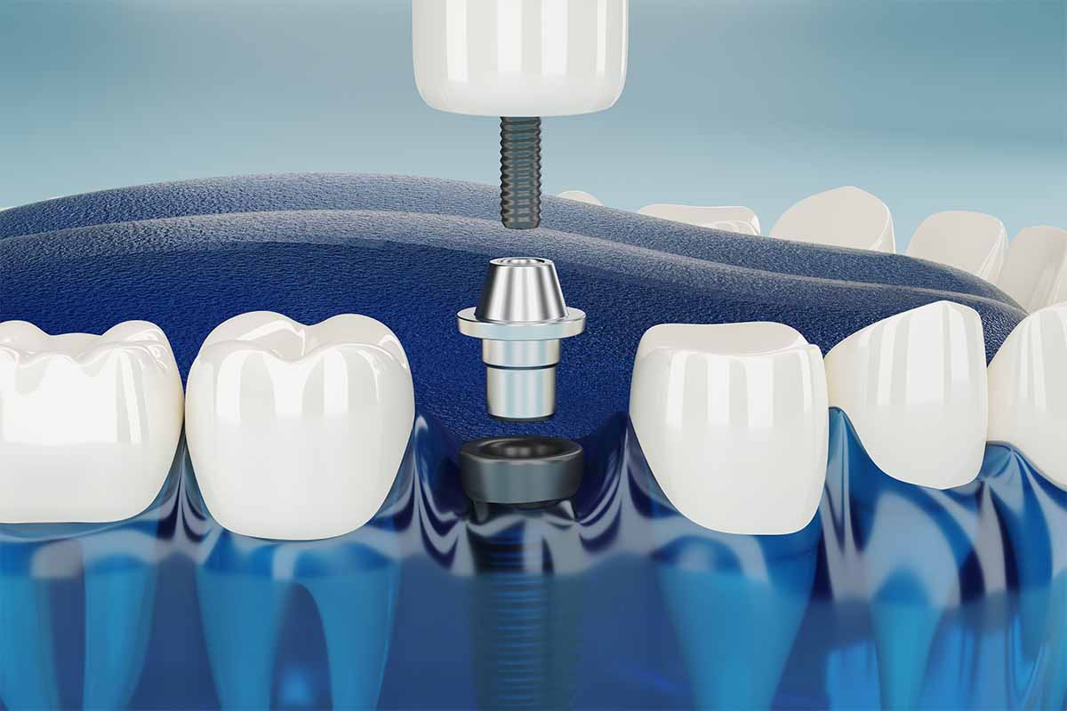 Kadıköy Anında Yükleme İmplant - Kemik Dental Clinic