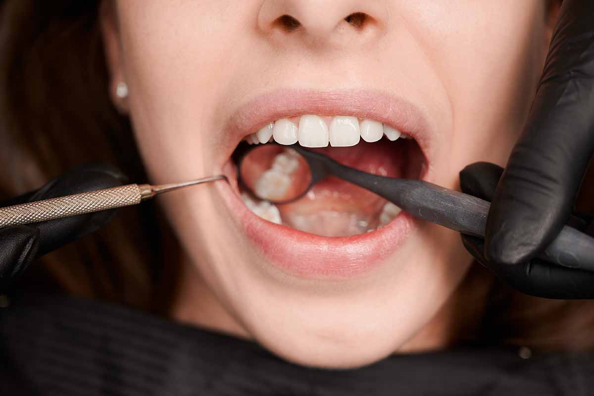 Kadıköy Diş Taşı Temizliği - Kemik Dental Clinic