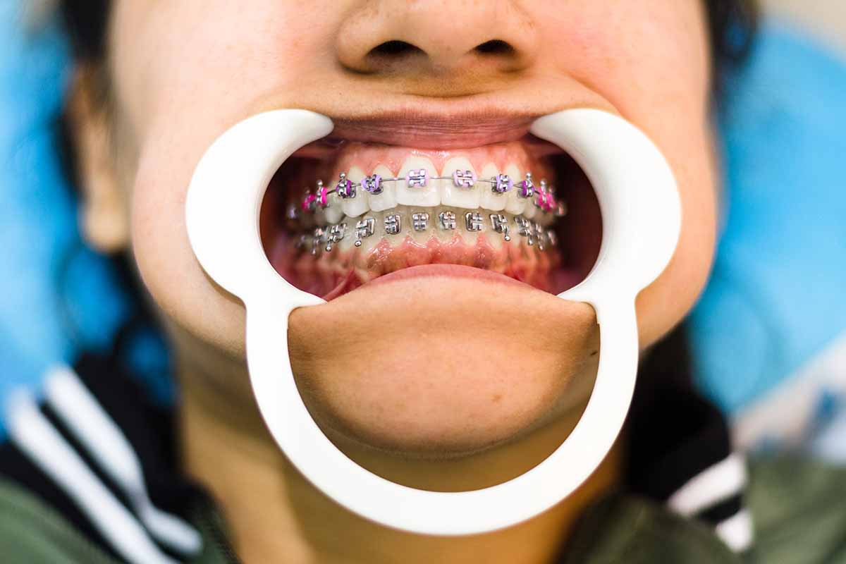 Kadıköy Lingual Ortodonti - Kemik Dental Clinic
