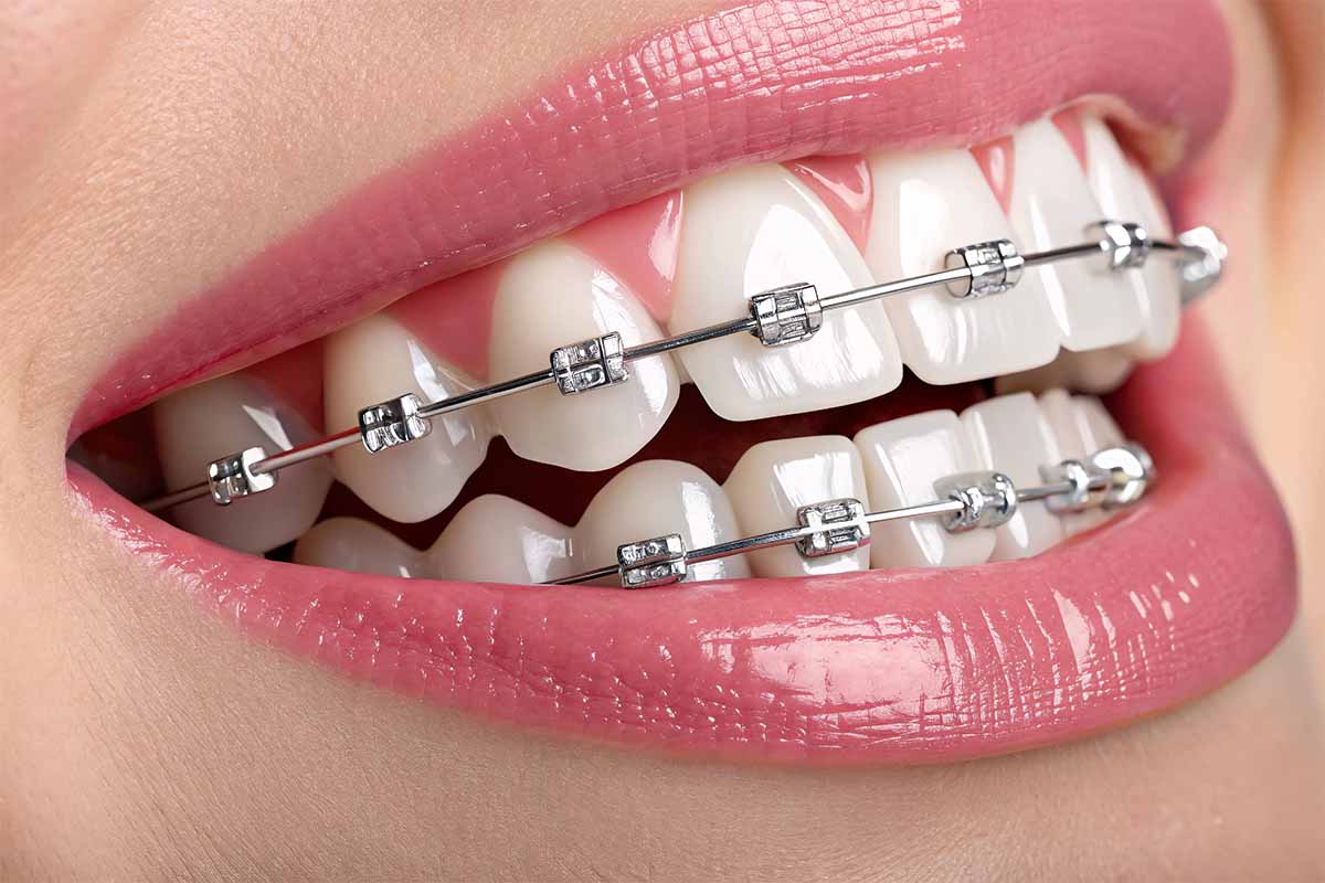 Kadıköy Metal Braket - Kemik Dental Clinic