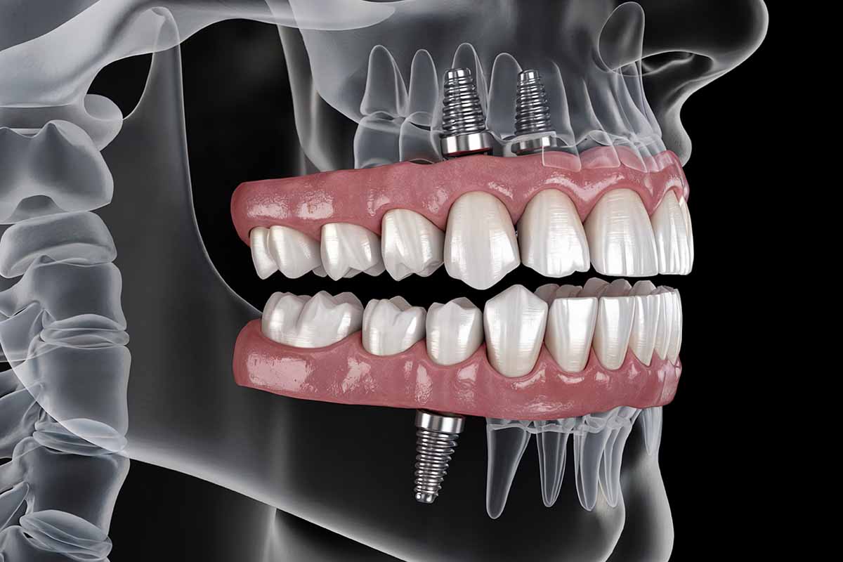 Kadıköy Zigoma İmplant - Kemik Dental Clinic