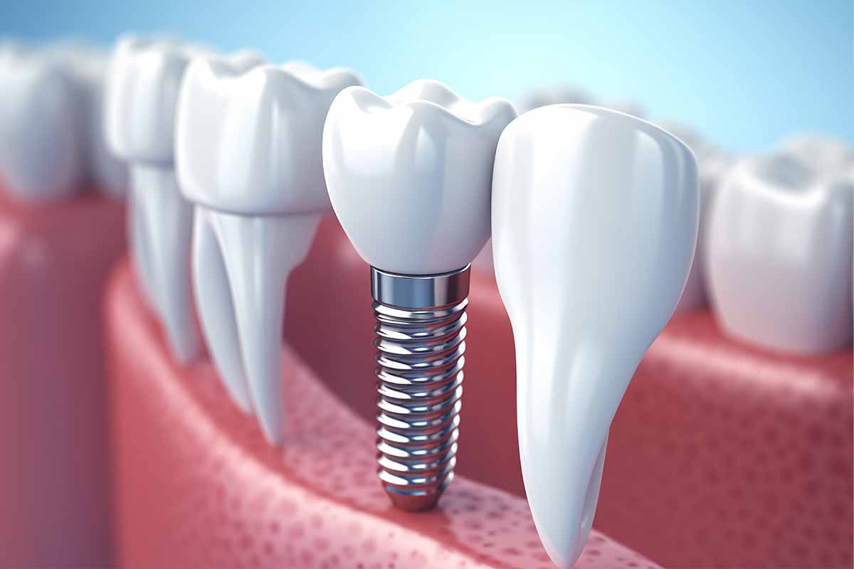 Kadıköy Zirkonyum İmplant - Kemik Dental Clinic