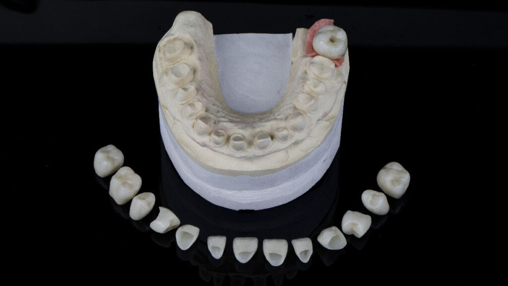 Eksik diş tedavisinde kullanılan dental implant ve diş köprüsü modellerinin karşılaştırmalı görünümü